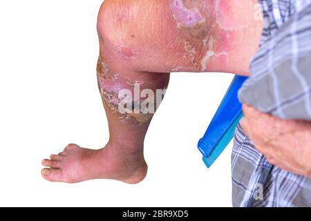 Erysipelas bacterial infection Under the skin leg aged people On white ...