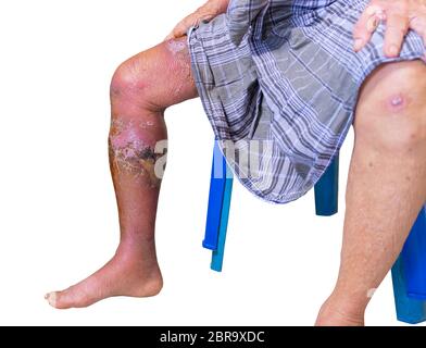 Erysipelas bacterial infection Under the skin leg aged people On white ...