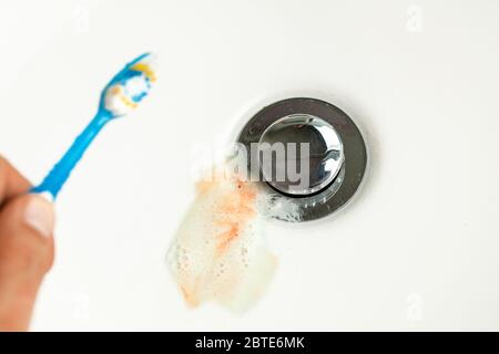 Toothpaste with blood in the sink after brushing your teeth. Bleeding gums. Stock Photo