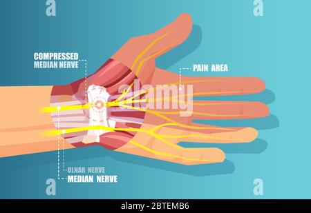 Medical illustration vector of a carpal tunnel syndrome with median nerve compression Stock Vector