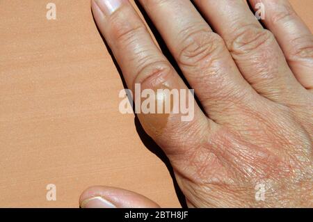 Large blister on woman’s hand caused by boiling water scald. Stock Photo