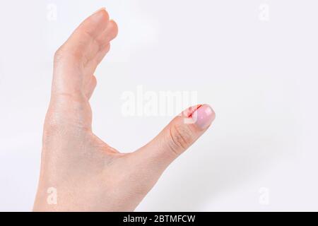 Bleeding hangnail closeup female hand injury. Bad habits, biting