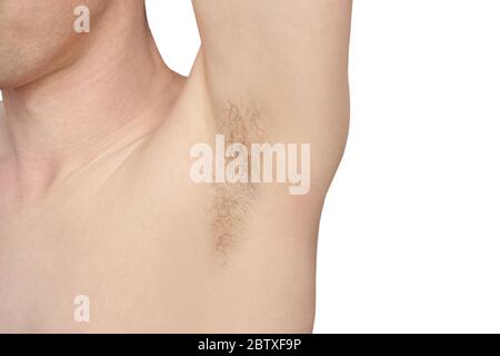 Girl underarm. White man armpit. Before and after epilation Stock Photo