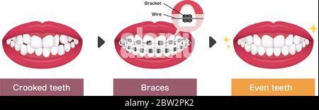 Dental braces process vector illustration Stock Vector