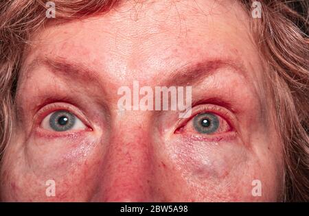 The face of a woman with severe redness and hemorrhage in the eye coronovirus. Close-up Macro. Ophthalmic eye problems. An allergic reaction is irrita Stock Photo