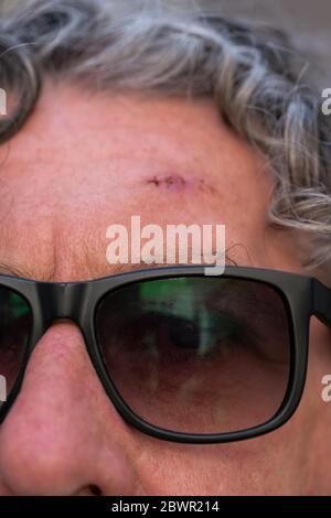 Close-up shot of a fresh operation wound with stitches showing scar on a mans forehead. Older man wearing sunglasses and greying curly hair. Stock Photo
