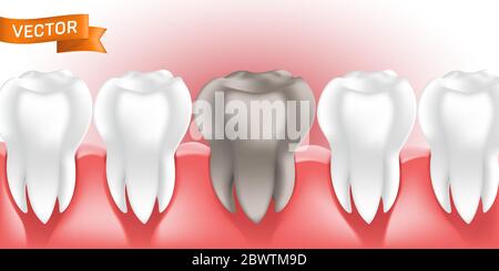 White healthy and clean human teeth in the gum with tooth decay or caries, 3D style vector illustration, can be used as dental and medicine concept el Stock Vector