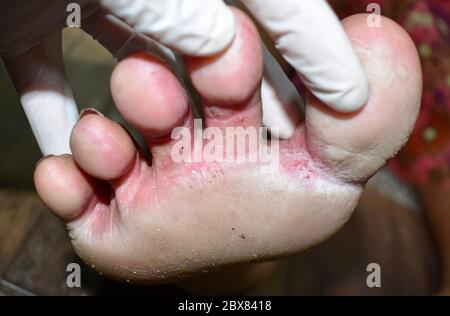 Fungal infection called tinea pedis at foot of Asian woman. It is itching lesion. Stock Photo