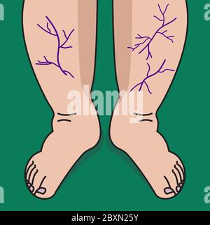 Varicose veins on legs of woman. Veins and vessels on shins Stock Vector