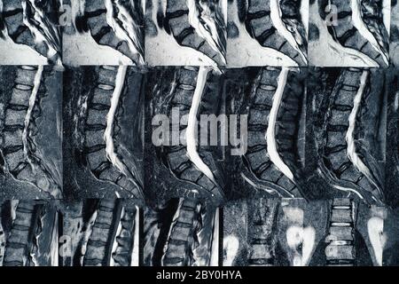 Macro photo of MRI of lumbar spine with osteochondrosis, age-related changes in discs of vertebrae and pinched nerves. Stock Photo