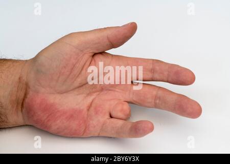 Left hand injury to ring finger. Ring finger amputation due to accident with propellor. Redness to bottom part of palm. Stock Photo
