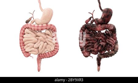 healthy intestines and disease intestines on white isolate. Autopsy medical concept. Cancer and smoking problem. 3d rendering Stock Photo