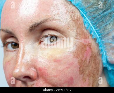 New skin after a chemical peeling, Stock Photo