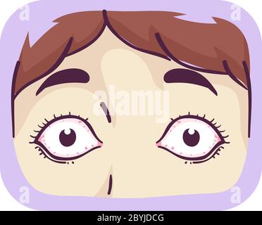 Illustration of Bulging Eyes of a Girl, Symptom of Graves Disease Stock Photo