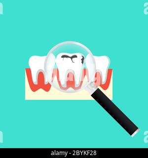 Caries dental problems. Tooth with caries icon with magnifier. Big hole in the human teeth on isolated background. EPS 10 vector. Stock Vector
