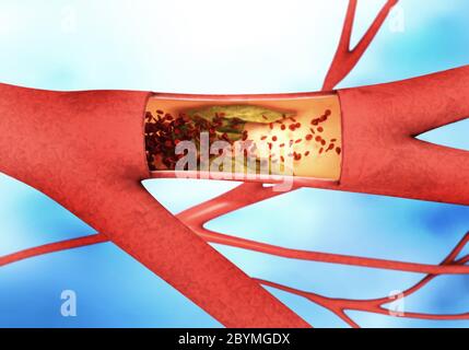 Cross section of a precipitating or narrowing blood vessels so called arteriosclerosis. Stock Photo