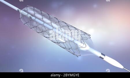 3d illustration of stent implantation for supporting blood circulation into blood vessels Stock Photo