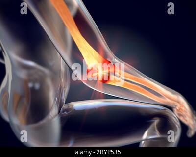 3d illustration of a injured elbow called lateral epicondylitis or tennis elbow Stock Photo