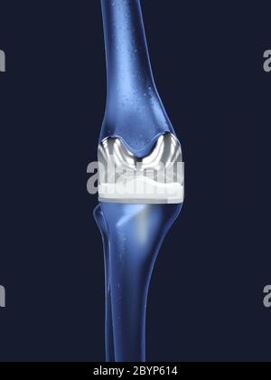 Artificial knee joint in blue shades - 3D Illustration Stock Photo