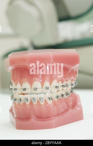 lower and upper dental jaw braces model Stock Photo