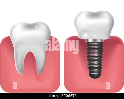 Dental implants, prosthetics 3D realistic style. Dentistry, healthy teeth concept. Vector illustration Stock Vector