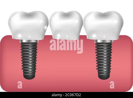 Dental implants, bridge construction, prosthetics 3D realistic style. Dentistry, healthy teeth concept. Vector illustration Stock Vector
