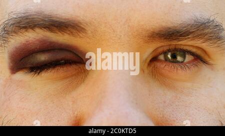 Man with shiner bruise black eye hematoma. Domestic violence male ...