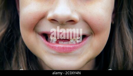 Brunette girl smiling and showing missing front teeth
