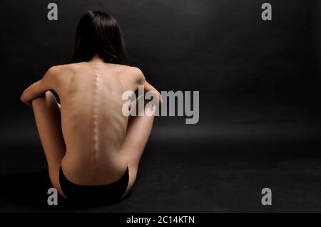 Rear View Of The Back Of A Thin Woman Stock Photo - Download Image Now -  Anorexia Nervosa, Back, Rear View - iStock