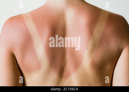 Close-up of a sunburn marks on a woman's back Stock Photo