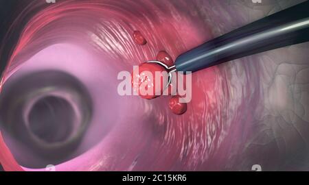 Removal of a colonic polyp with a electrical wire loop during a colonoscopy - 3d illustration Stock Photo