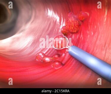 Removal of a colonic polyp with a electrical wire loop during a colonoscopy - 3d illustration Stock Photo