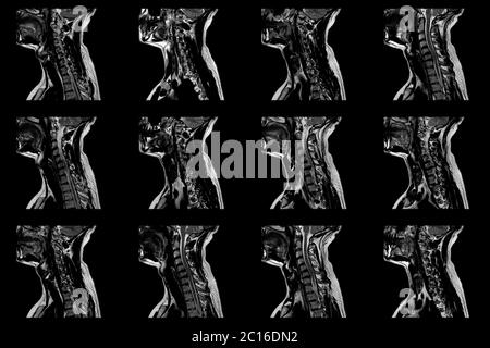 Set Of Sagittal MRI Scans Of Neck Area Of Caucasian Male With Bilateral ...