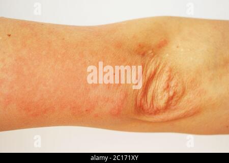 Red pustules and vesicles on the skin of the hand as symptoms of photodermatitis. Allergic reaction to sunlight. Allergy Stock Photo
