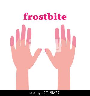 Frostbite. Hands with different skin colors due to low temperature and frost Stock Vector