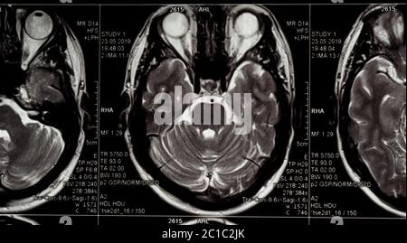 Brain MRI slide of a young man, eyes are seen Stock Photo