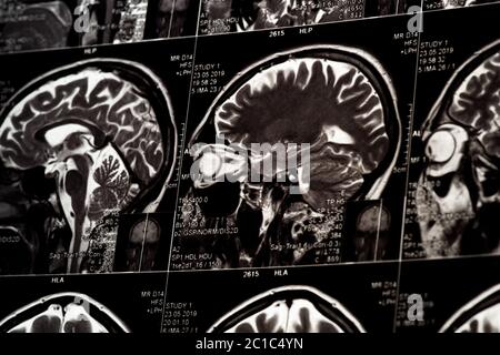 MRI scan of human brain, monochrome Stock Photo
