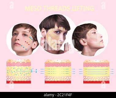 Meso thread Lift. Young female with clean fresh skin. Beautiful woman. face and neck. Lifting by threads concept Stock Photo