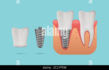 Dental implant structure, human teeth and dental implant, vector illustration Stock Vector