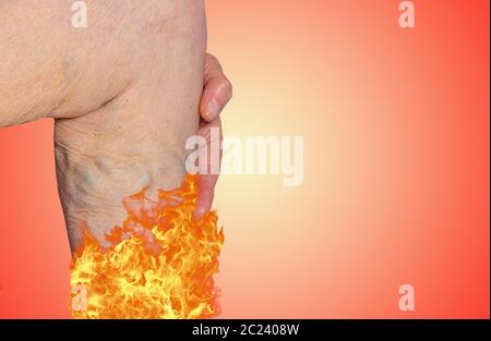 Varicose vein on a female senior legs. The structure of normal and varicose  veins. Concept of dry skin, old senior people and deep vein thrombosis or  Stock Photo - Alamy