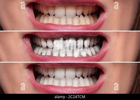 Close-up Detail Of Smiling Woman Teeth Before And After Cleaning With Charcoal Toothpaste Stock Photo