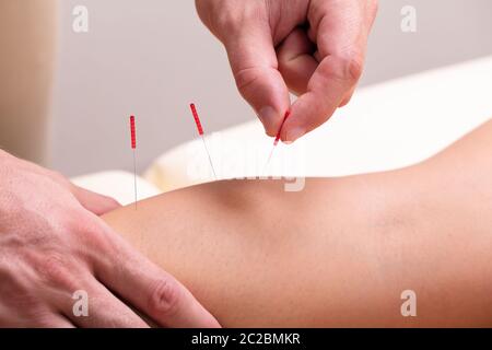 Close-up Of A Therapist Giving Acupuncture Treatment By Inserting Needles On Woman's Knee Stock Photo