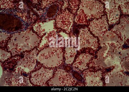 Pulmonary tuberculosis tissue under the microscope 200x Stock Photo