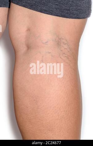 Varicose spider veins on womans legs Stock Photo