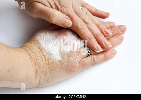 A woman rubs her hands with an ointment of pain. Hand cream against dry skin Stock Photo