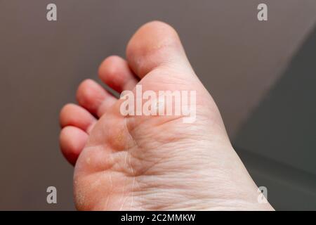 Plantar wart on the human foot Stock Photo