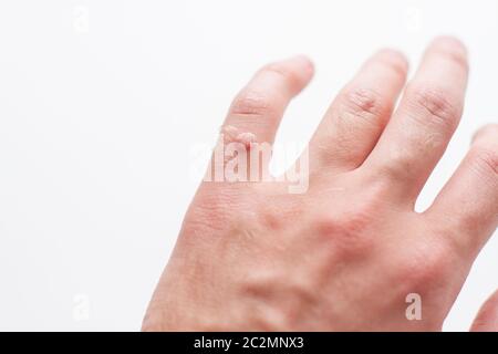 wart on finger hand isolated on white backogrund, close up Stock Photo