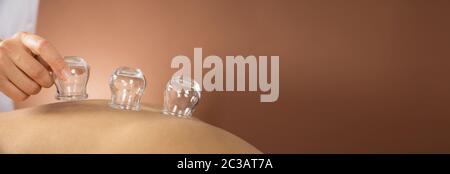 Close-up Of A Therapist Hand Giving Cupping Treatment In Spa Stock Photo