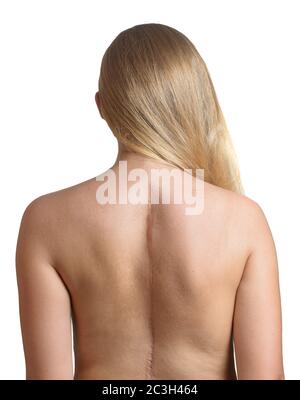 Young woman with scars from spinal surgery. Stock Photo