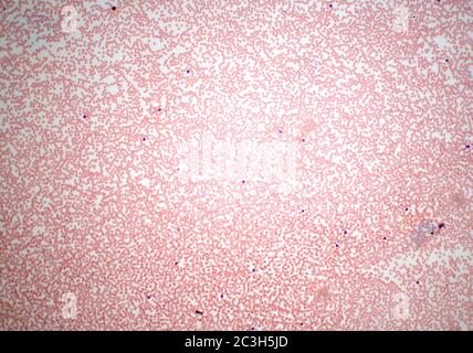 Microscope slide smear sample of human blood cells Stock Photo